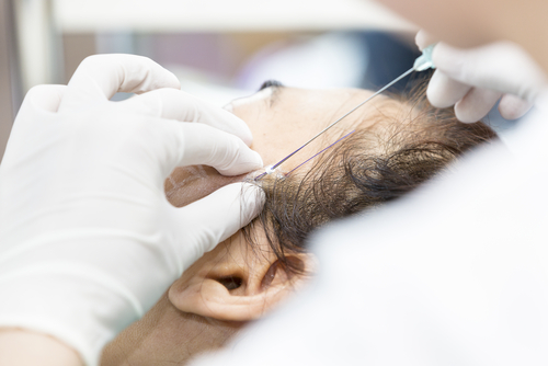 What Is a Thread Lift Procedure?